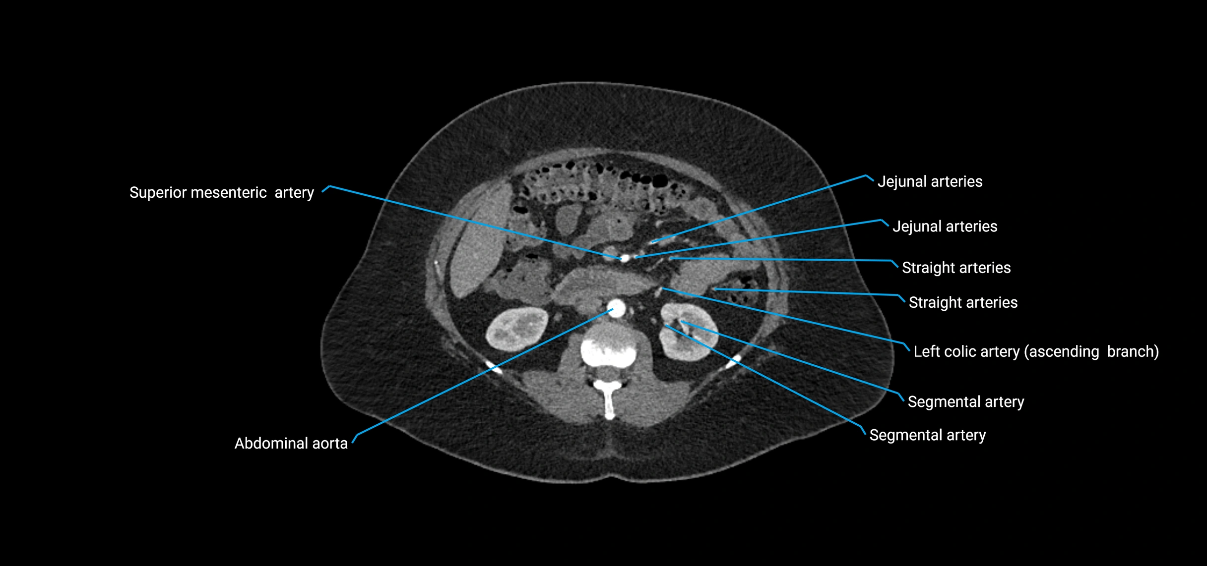 CTA abdomen axial cross sectional anatomy labelled image_84 (2).webp